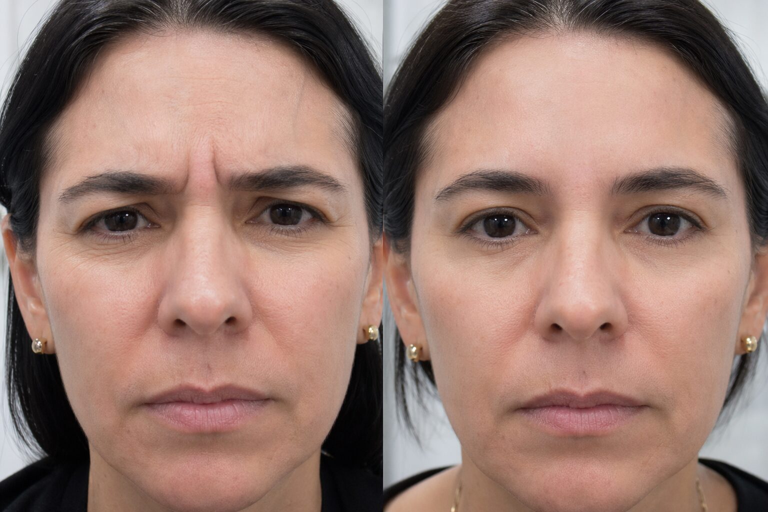 Toxina botulínica - antes y después ilustrativo