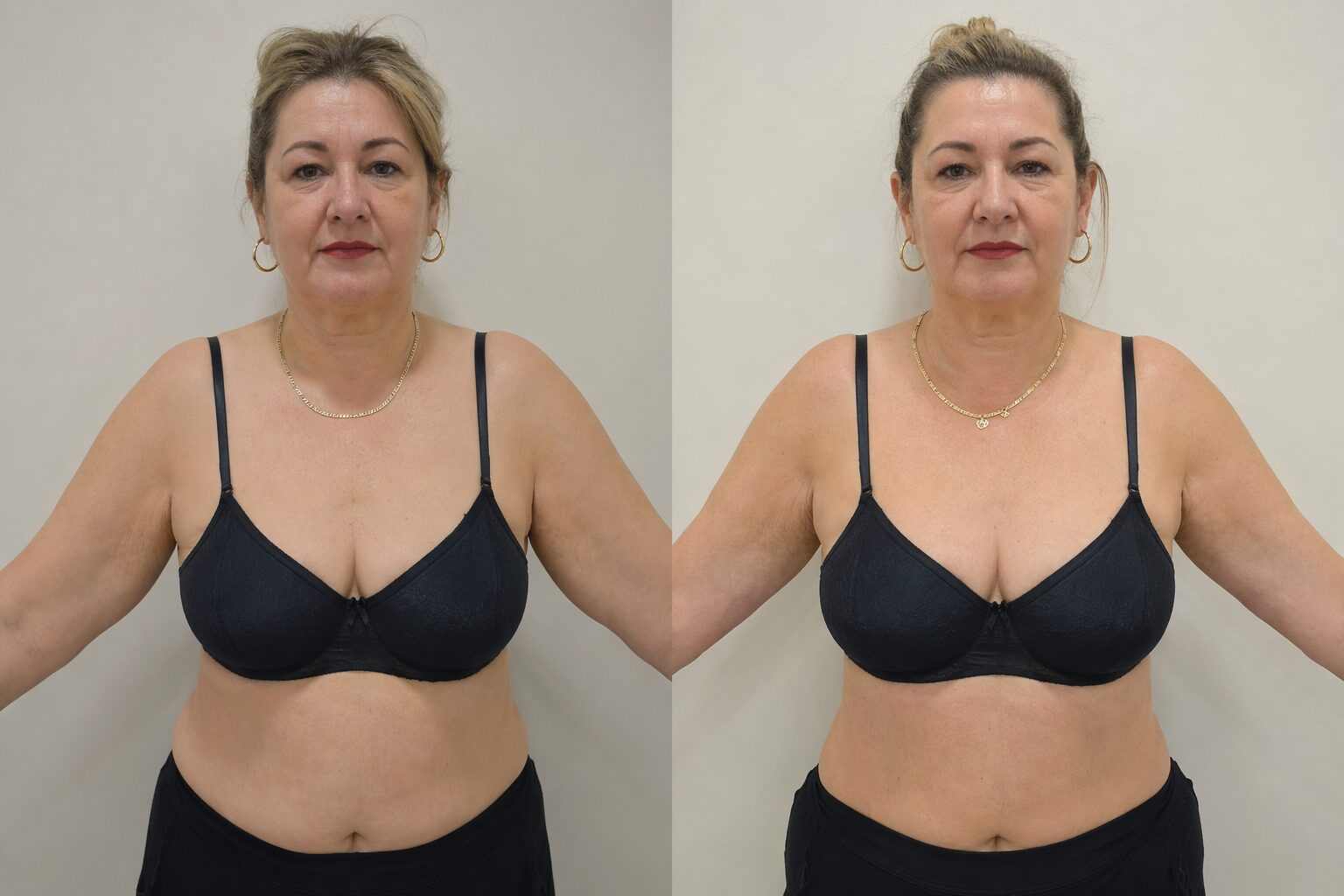 Braquioplastia - antes y después ilustrativo