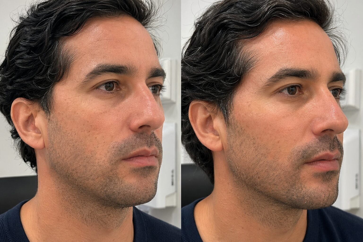 Implantes faciales - antes y después ilustrativo