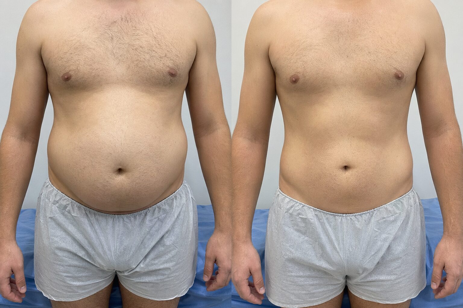 Liposucción o lipoescultura - antes y después ilustrativo