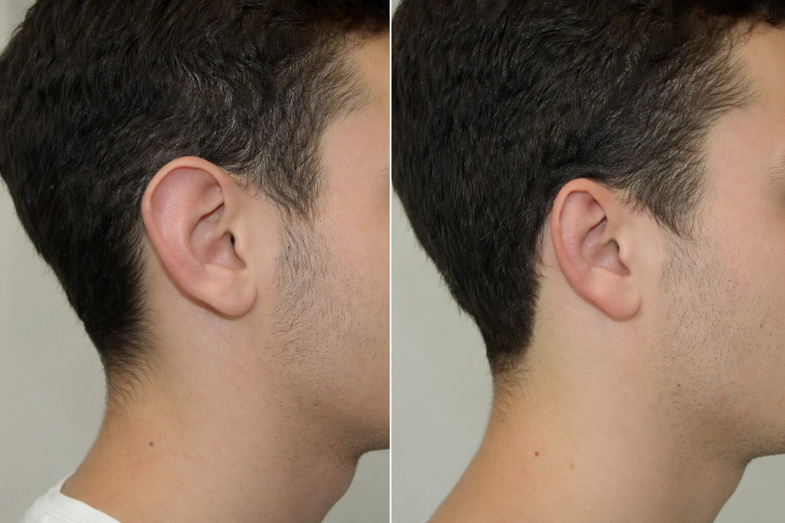 Otoplastia - antes y después ilustrativo
