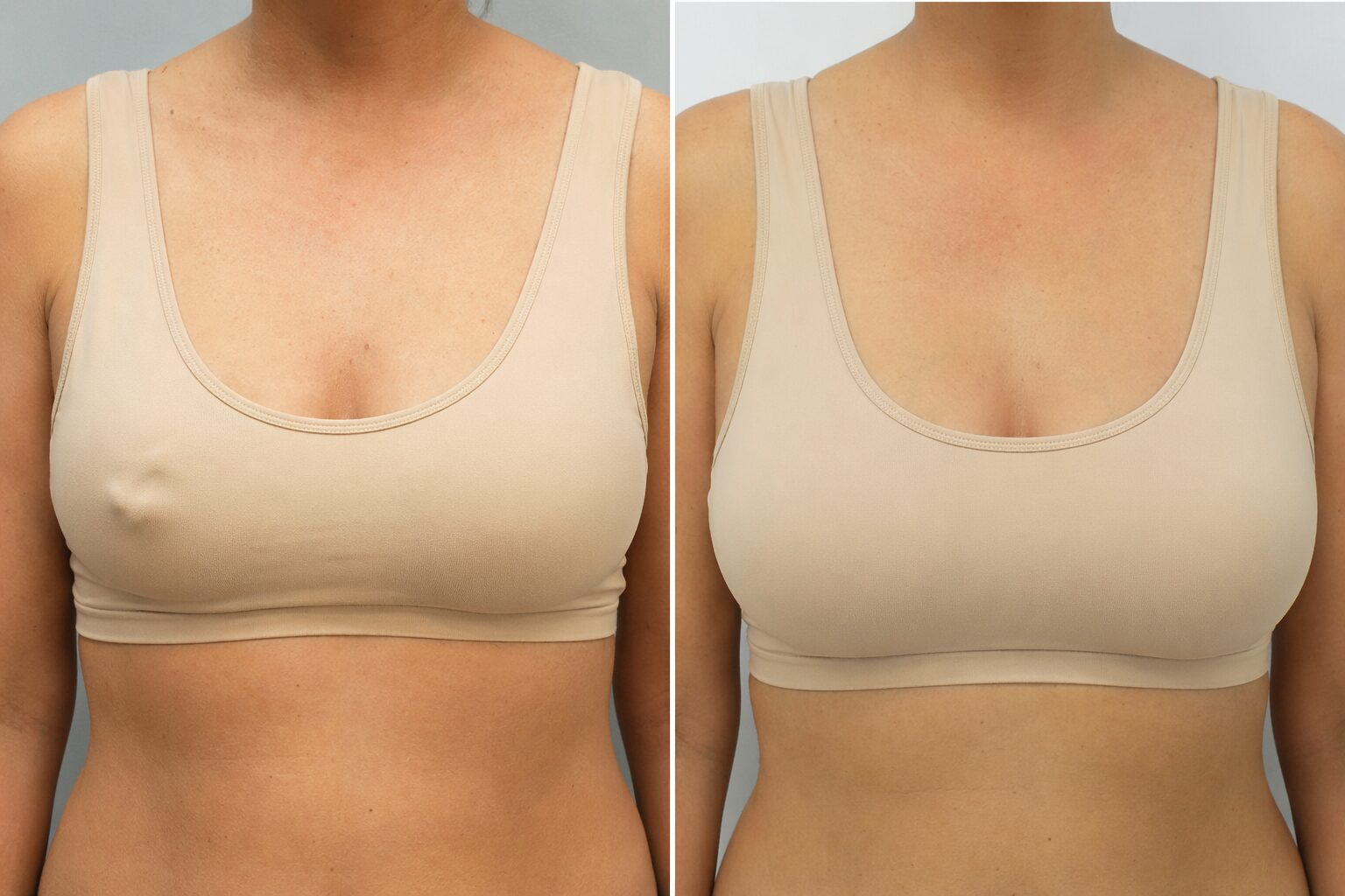 Recambio de implantes - antes y después ilustrativo