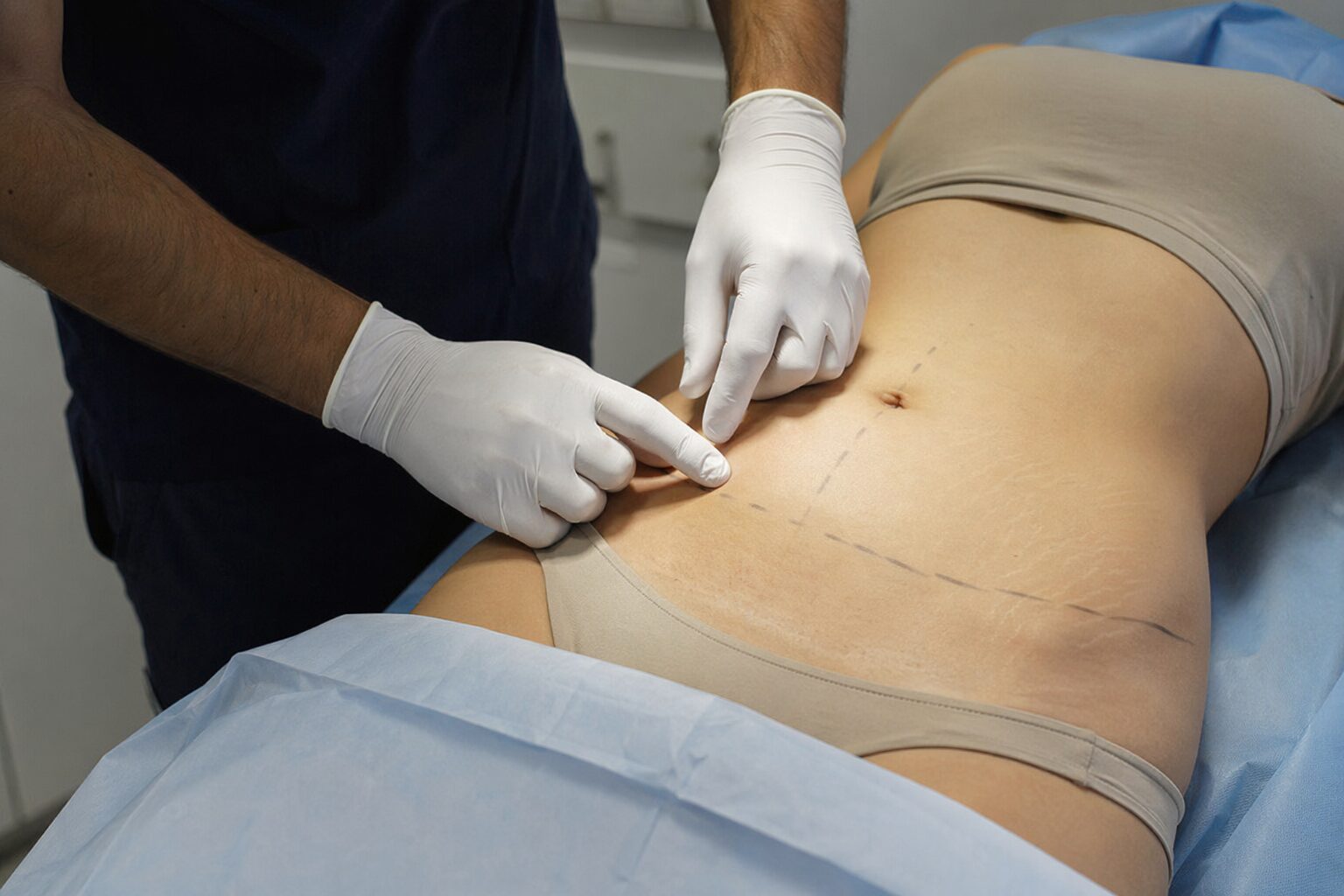 Abdominoplastia - imagen ilustrativa del procedimiento