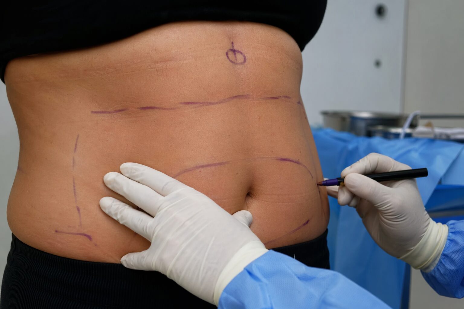 Liposucción o lipoescultura - imagen ilustrativa del procedimiento